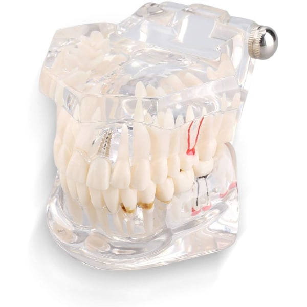 1 hammaspatologian malli irrotettava malli aikuisen kokosuun malli