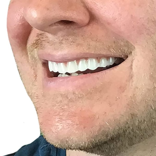 3 instant fanerproteser Bekväma övre leende tänder Vita