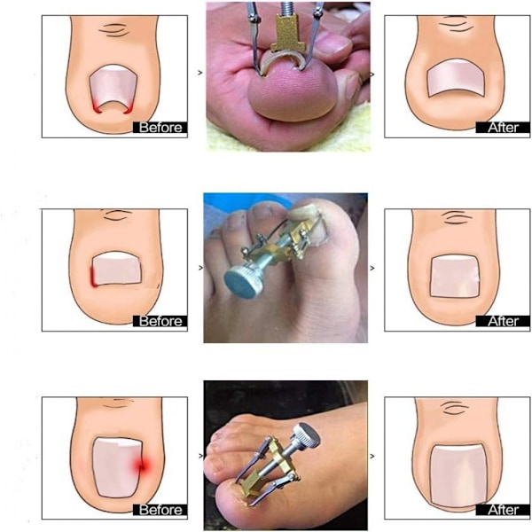Tånagelskorrigerare för Professionell Nagelbehandling, Inåtväxt Tånagellyftare Smärtfri Nagelkorrigering för Mångsidigt Nagelverktyg, Högkvalitativ Zinkaluminium