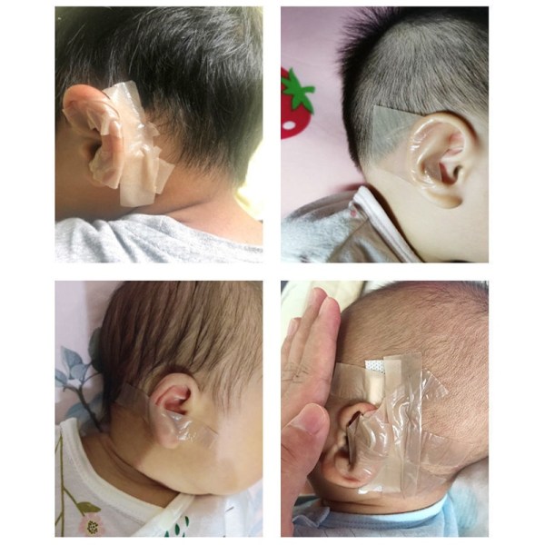 Baby ørekorrektorer Silikontape Spedbarns ørekorreksjon - Perfet 4cm*100cm