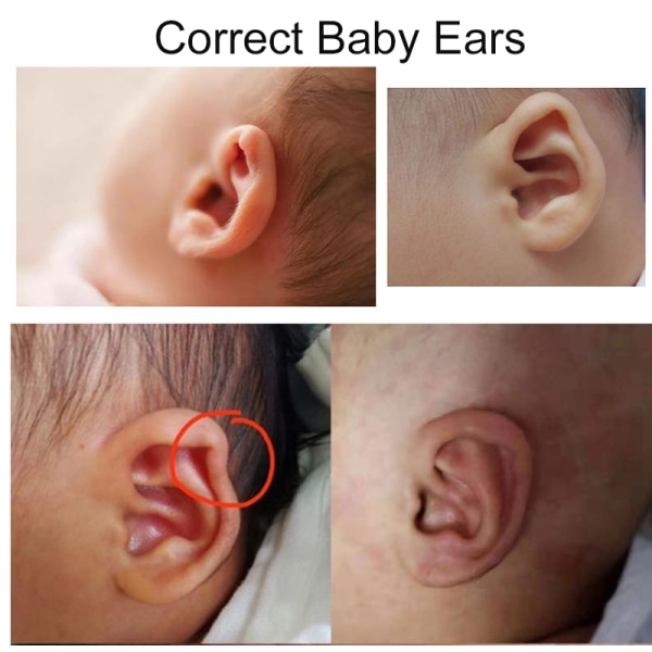 Baby ørekorrektorer Silikontape Spedbarns ørekorreksjon - Perfet 4cm*100cm