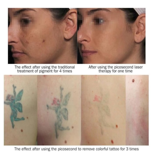 ZJCHAO Picosecond Laser Pen Tatuering Ärr Freckle Borttagning Maskin Hud Skönhet Device