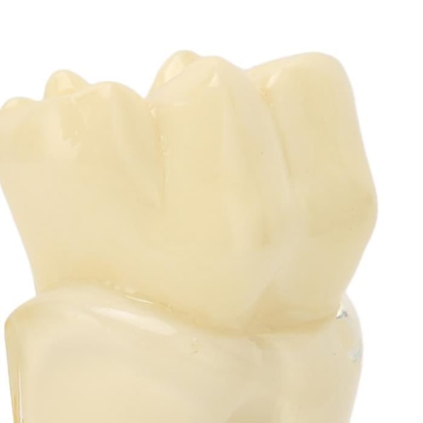 HURRISE Kariestandmodell Akryl Dentalkariesmodell 6 gånger sönderfallen tandmodell Utbildningsmaterial