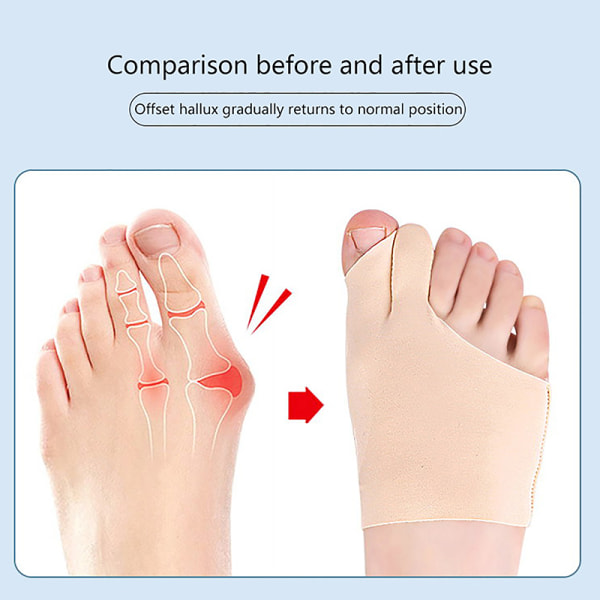 1 Pari Toe Hallux Valgus Corrector Feet Care Bone peukalon säädin