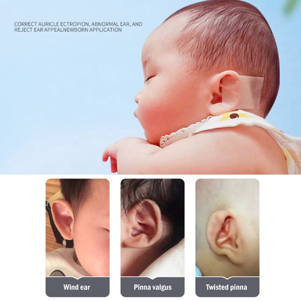 Silikon baby ørekorrektor Spedbarns utstående ører korrigering 4 d7c7 |  Fyndiq