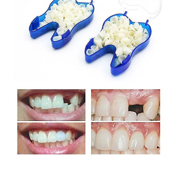 Väliaikaiset hammasproteesit peittävät yläproteesit, viilut, puuttuvat hampaat, katkenneet hampaat ja hampaiden väliset raot