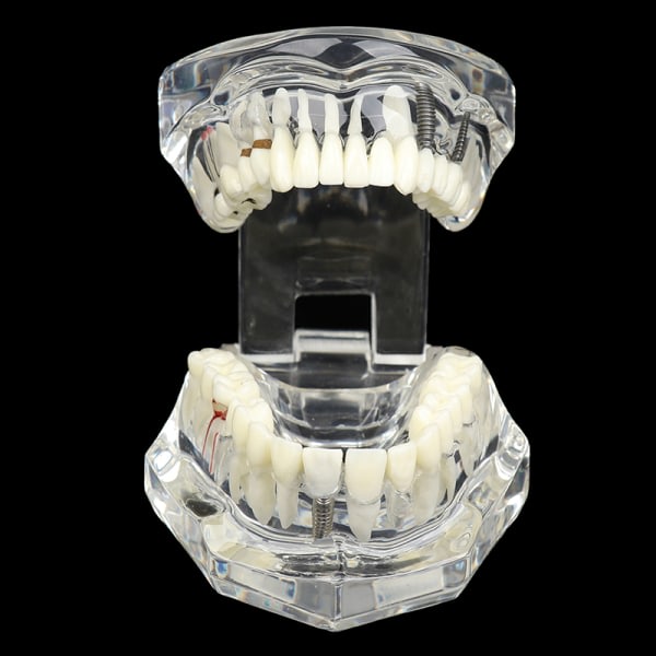 Dental Model Im Restoration Bridge for studiet og videnskab