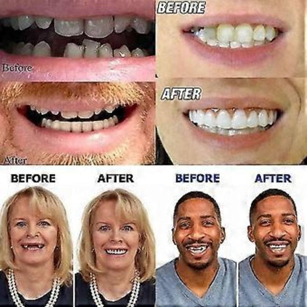 Kunstige Tænder Gebis Provisorisk Hurtig Tandprotese Top Perfekt Smil Facader, Reparer Din T