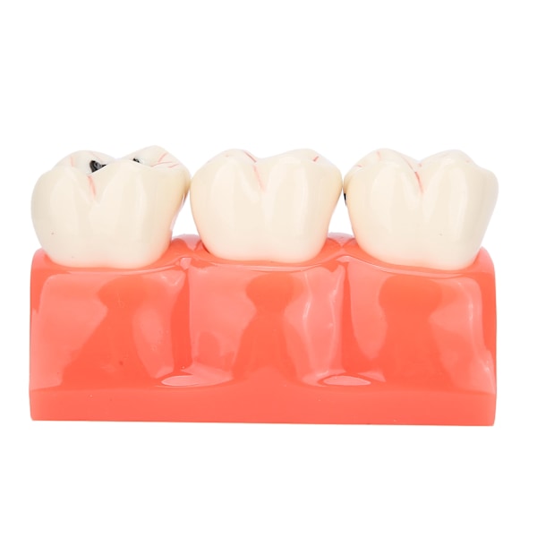 Högt Simulerad Dental Undervisningshjälp, Syntetisk Hartstandmodell För Professionell Träning Och Utbildning, Tydlig Morfologisk Struktur, Vuxen