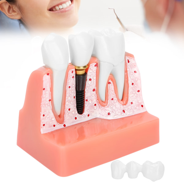 Visuell förklaring av dental anatomi, högkvalitativ demonstrativ implantatmodell med avtagbar krona för juridiska presentationer och utbildning