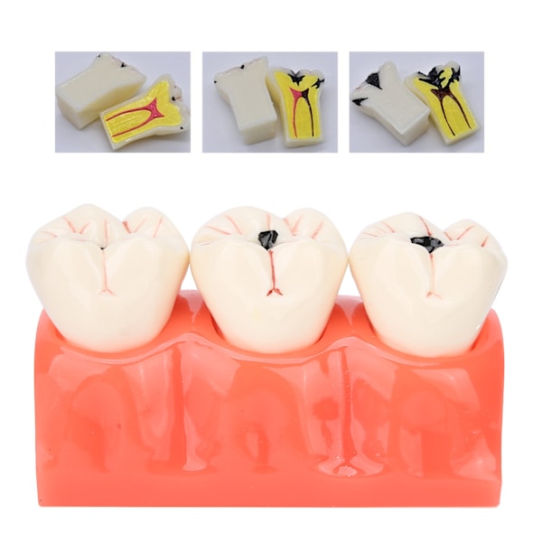 Högt Simulerad Dental Undervisningshjälp, Syntetisk Hartstandmodell För Professionell Träning Och Utbildning, Tydlig Morfologisk Struktur, Vuxen