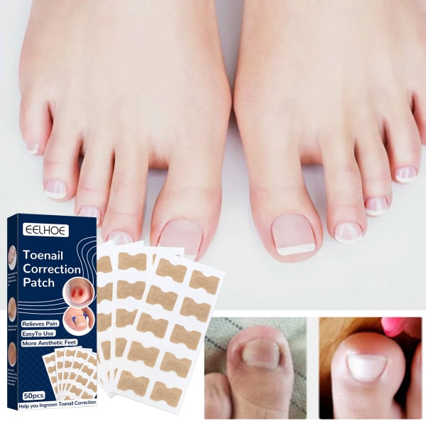 100 st Nagelkorrigeringsdekaler Paronychia Treatment Recover, ZQKLA