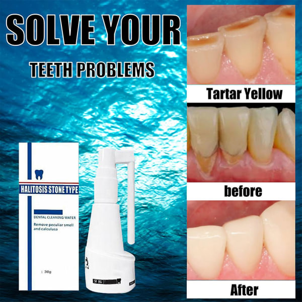 2x Calculus Dissolving Dental Spray Suun hampaiden puhdistusaine hammaskiven poistoaine