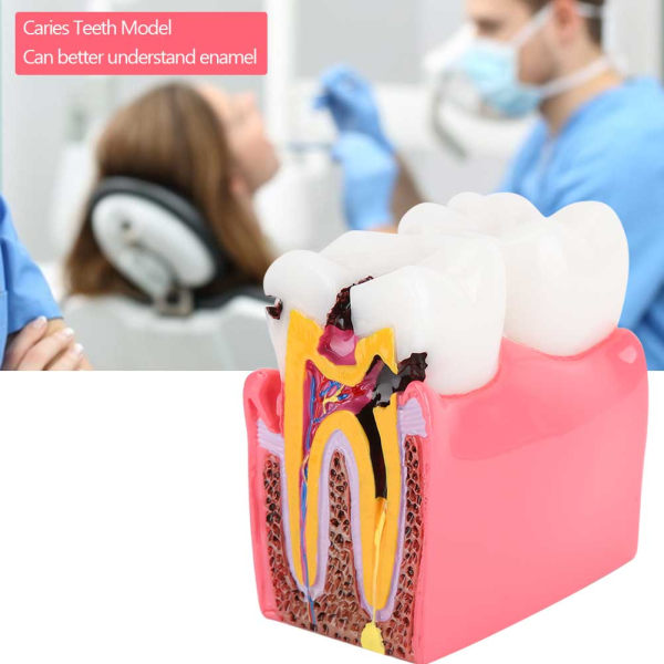 Caries sammenligningsundersøgelsesmodeller Tandlæge Tandlægeanatomi Uddannelse Tandmodel++/