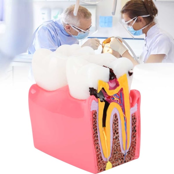 Caries sammenligningsundersøgelsesmodeller Tandlæge Tandlægeanatomi Uddannelse Tandmodel++/