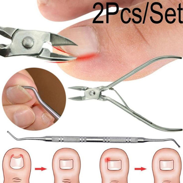 2st Inåtväxande tånaglar Pedikyr Fotvårdsverktyg Nagelkorrigering C one size