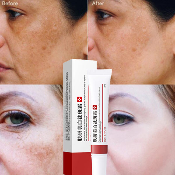 Whitening Freckle Cream Remove Melasma Acne Spot Pigment Melani 20g