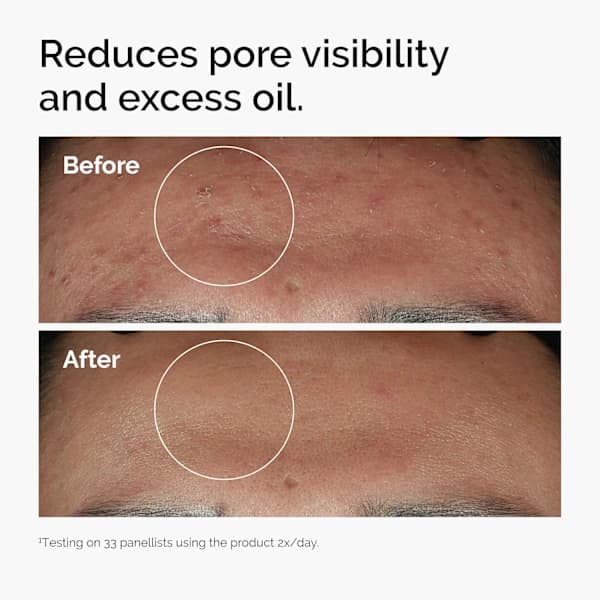 The Ordinary Niacinamide 10% + Zink 1%, Lystergivande Serum, Reducerar Ojämnheter, 30ml