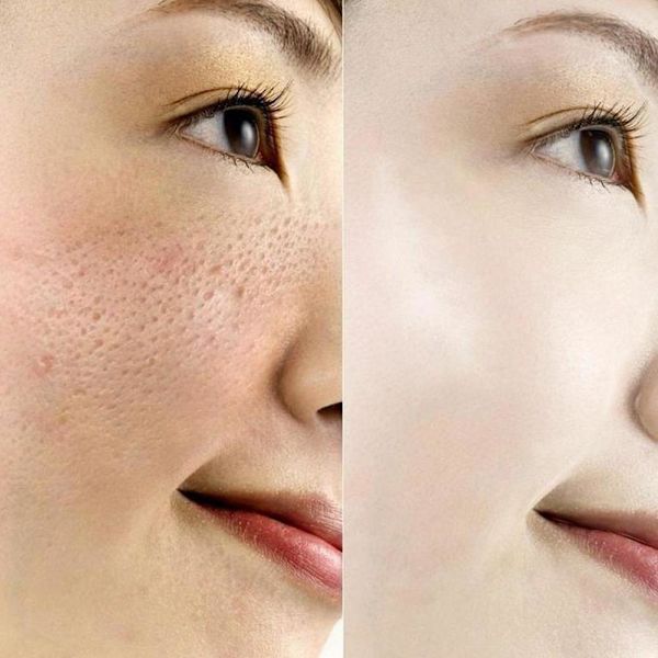 Vanlig glykolsyra 7% toning Resurfacing Solution-