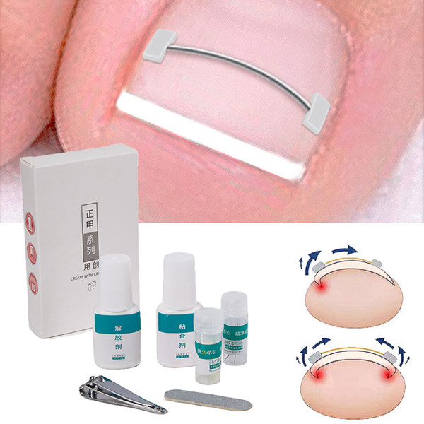 Inåtväxande tånagelkorrigering Tåfot Nagelkorrigeringsdekal Pedi 02 onesize