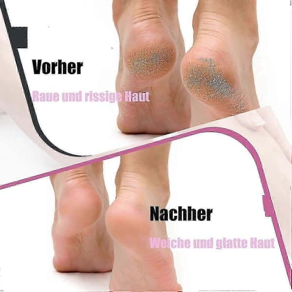 Myeluna Footglow Callusfjerner med 60 erstatningsslipeputer for død hard sprukken hud