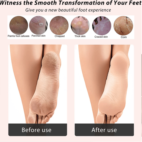 Elektrisk fodfil Callus Remover
