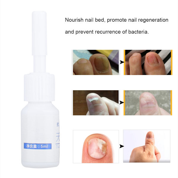5ml Nagel Svampbehandling Anti-svamp Mjukgörande Finger Tånaglar Vård Reparationsvätska