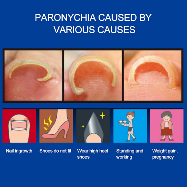 4 st/set Paronychia Behandlingsdekaler Inväxt tånagel Korrigerare Fotnagel Korrigeringsverktyg