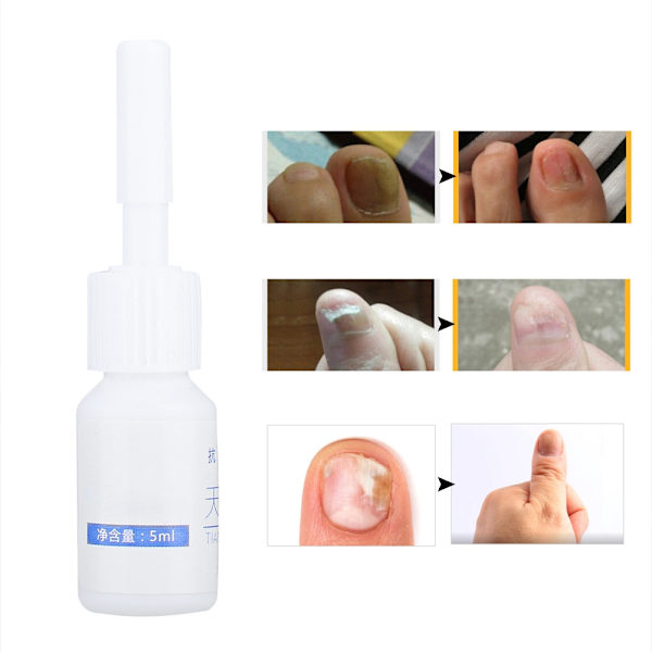 5ml Nagel Svampbehandling Anti-svamp Mjukgörande Finger Tånaglar Vård Reparationsvätska