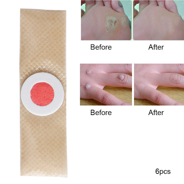 6 stk/pose Fodmajsfjerner Plaster Vorter Torn Plaster Fødder Callus Fjernelse Smertelindring Mærkater