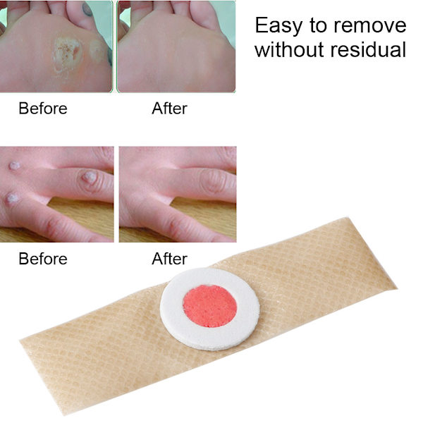 6 stk/pose Fodmajsfjerner Plaster Vorter Torn Plaster Fødder Callus Fjernelse Smertelindring Mærkater
