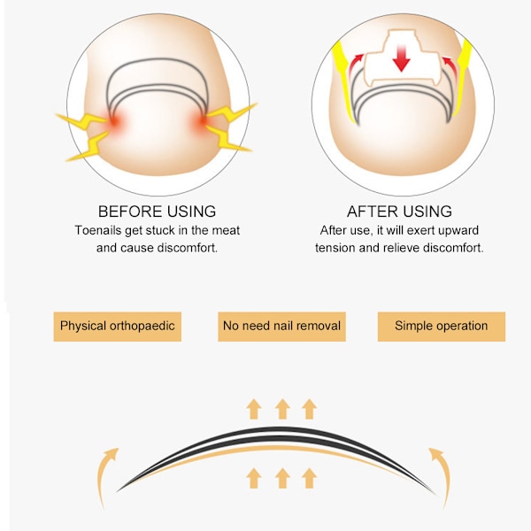 Inngrodd tånegl korreksjonsplaster Inngrodd negl korrigerer neglinnsats spenne død hud gaffelsett44