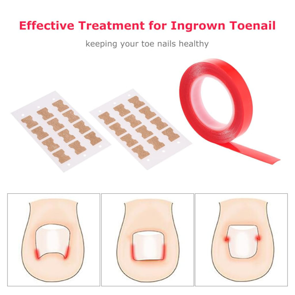 30 st Ingrown tånagelkorrigeringsplåster Andningsbar elastisk bomullsgluggplåster Tumme Böjd tånagelstöd Pedikyrverktyg