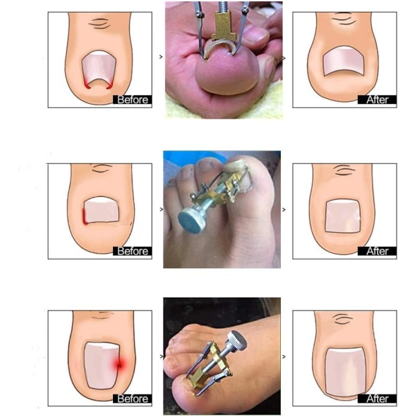 Professionellt verktyg för korrigering av nageltrång, nagelklipp för nageltrång, regenererar nageltrång, pedikyr