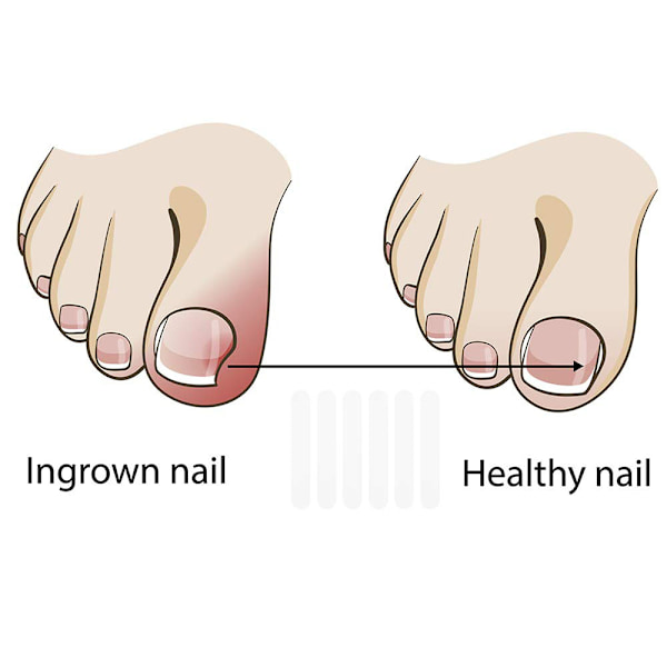 10 st Ingrown tånagel Pedikyrverktyg Räta ut klämma Böjd Br