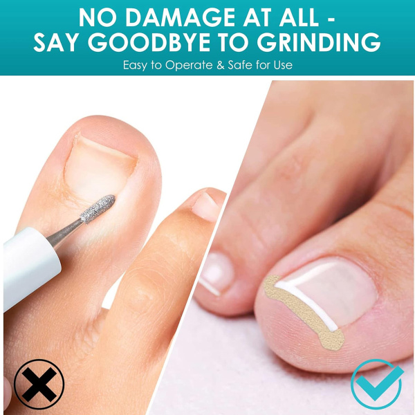 Behandling av inåtväxande tånagel-tånagelkorrigeringsplåster med fil och lyftare-inåtväxande tånagelkorrigeringsremsor och smärtfritt pedikyrverktyg