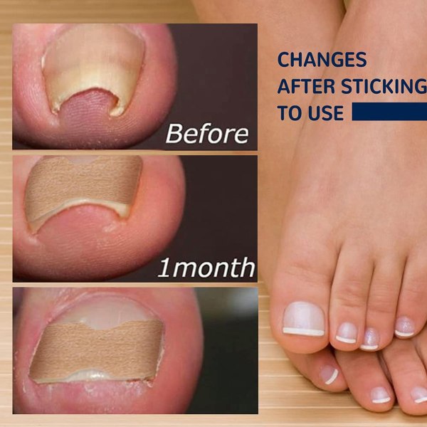 Tånagelkorrigeringsplåster, inåtväxande tånagelkorrigeringsremsor utan lim, smärtfri och effektiv korrigering av inåtväxta böjda tånaglar