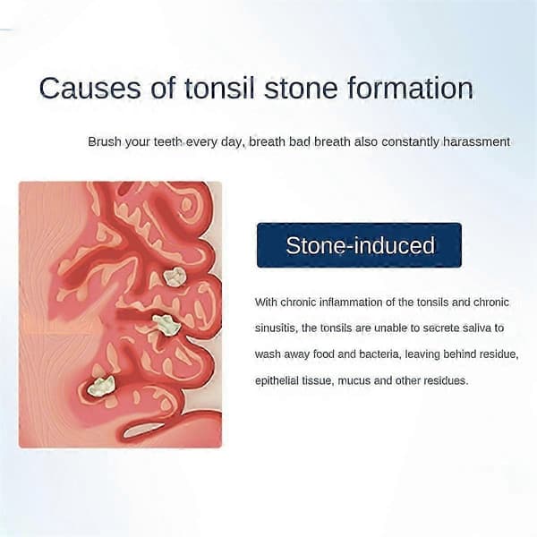 Electronic Tonsil Stone Remover, Tonsil Stone Removal Kit, Instant Suction Tonsil Stone Removal