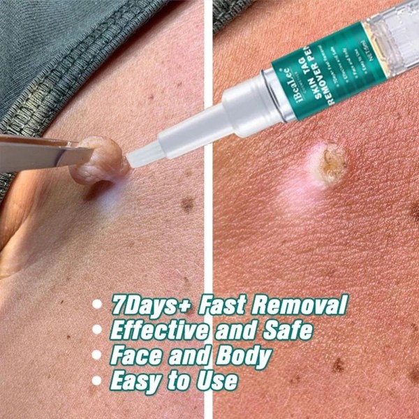 Mordely Skin Tags Remover Smärtfri Skin Dark Spot