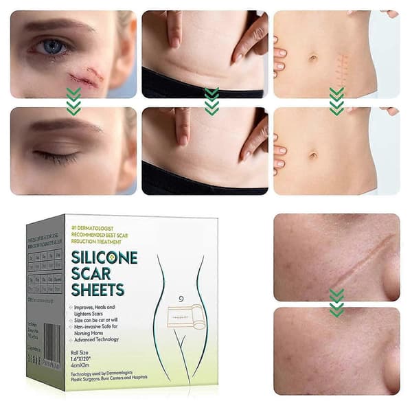 4 cm silikone arfjernelsestape efter operation ar behandlingsark smertefri arreparationsbandage, længde Multicolor Nude