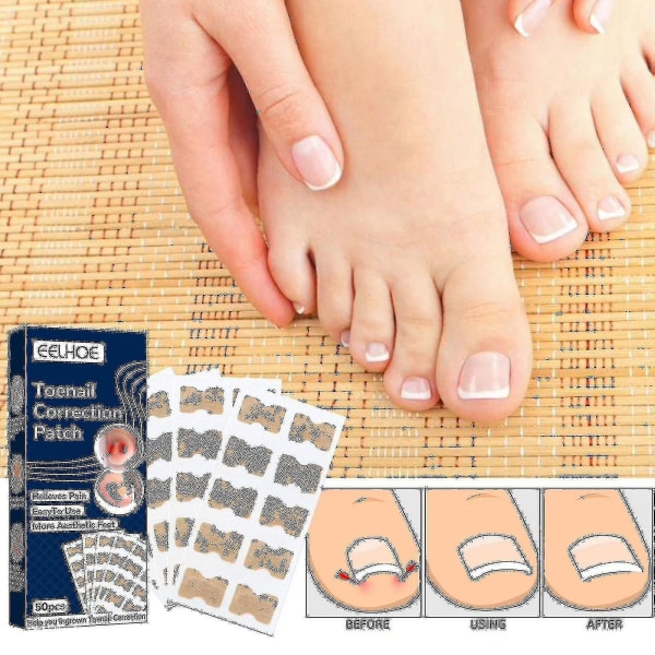 Inngrodd tånegl-klistremerke med tåneglehøvlerverktøy Tåneglkorrigeringslapp Tåkorreksjonsklistremerke-hy