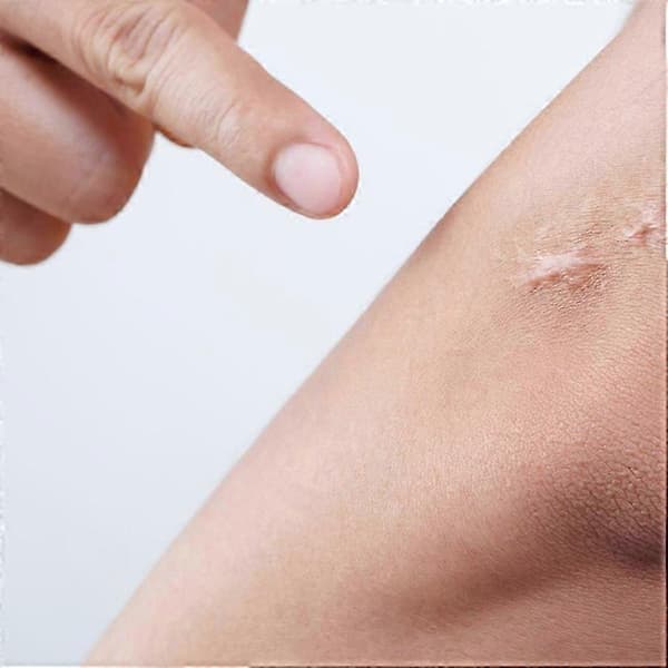 Is Repair stick til huden, silikone arstift, arfjernelsesstift, til arreparation 2pcs