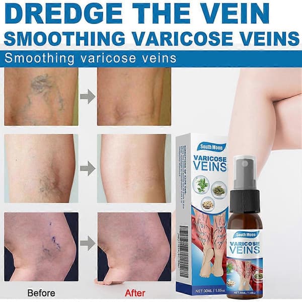 Spray mot åderbråck för ben Åderbråck, Vein Guard Herbal Spray Åderbråcksbehandling Spray 1pc