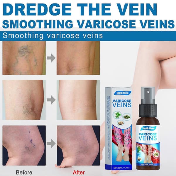 Åderbråcksmassagespray Lindrar Åderbråck och Jämnar Ut Vaskulära Utbuktningar