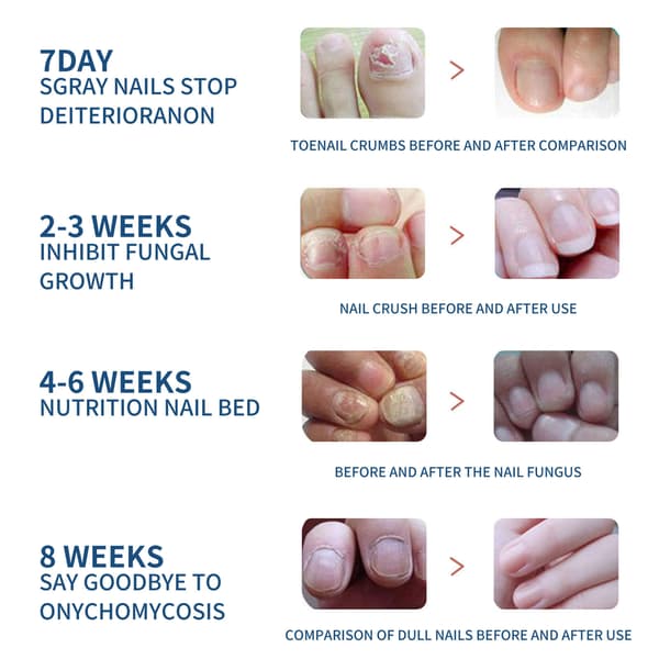 Nagelbehandlingsplåster, nagelreparationsplåster, nagelsvampbehandling