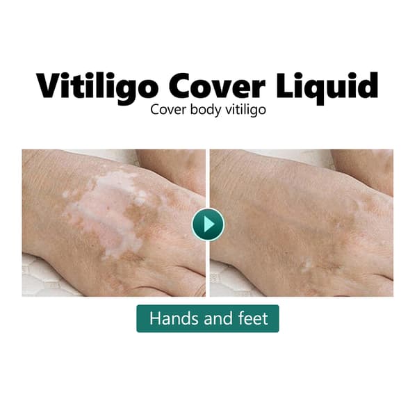 Vandtæt Vitiligo Dækstift Makeup til Ansigt og Krop 20ml