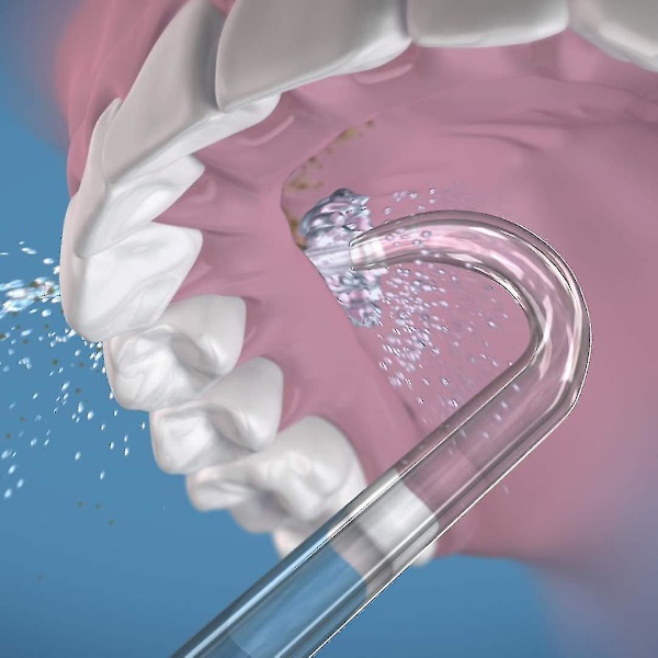 2 Vaihtokärkeä Implanttihammasproteeseihin [HK]