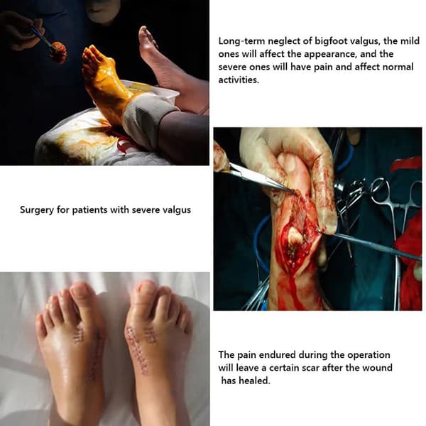 2 stk. Hallux Valgus-korrigerer for kvinner, universelle tommelsplinter, oversydd