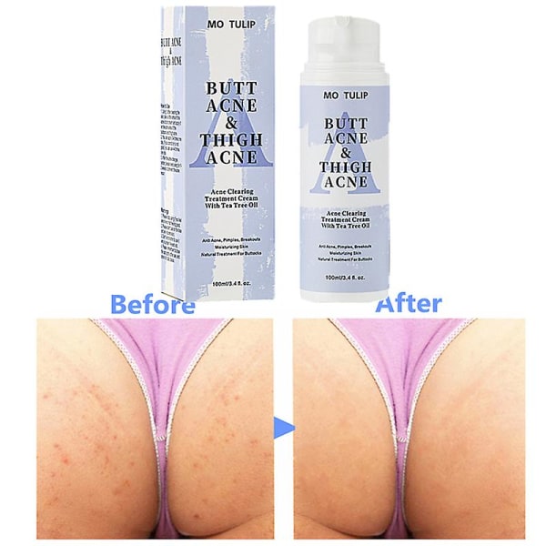 100ml Butt Acne Clearing Spot Treatment Cream Rensar akne finnar Zits Rakbultar och mörka fläckar för skinkorna Lårområdet