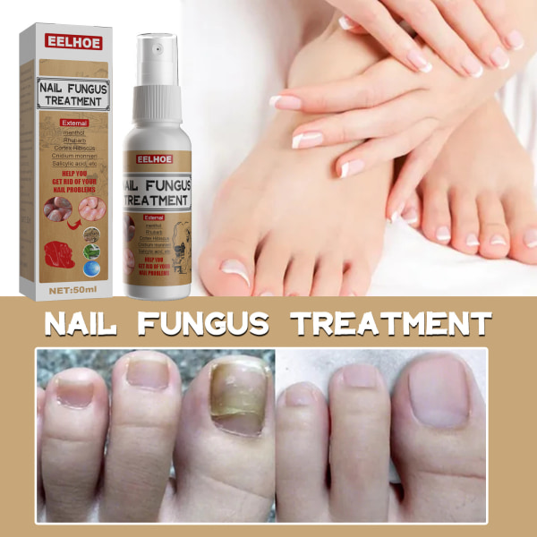 1 förpackning - Nail Repair Spray - Nail Mycosis Treatment - Behandlar nagelsvamp och ökar nagelåterväxten - Lätt att använda - 50ml